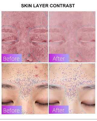 खरीदें Blue Light Acne Treatment Mask with Intelligent Timer – Manufacturer Direct Supply, Appearance Patent Included ऑनलाइन निर्माण